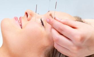 Acupuncture