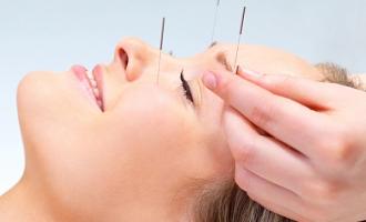 Acupuncture