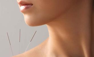 Acupuncture - First Session